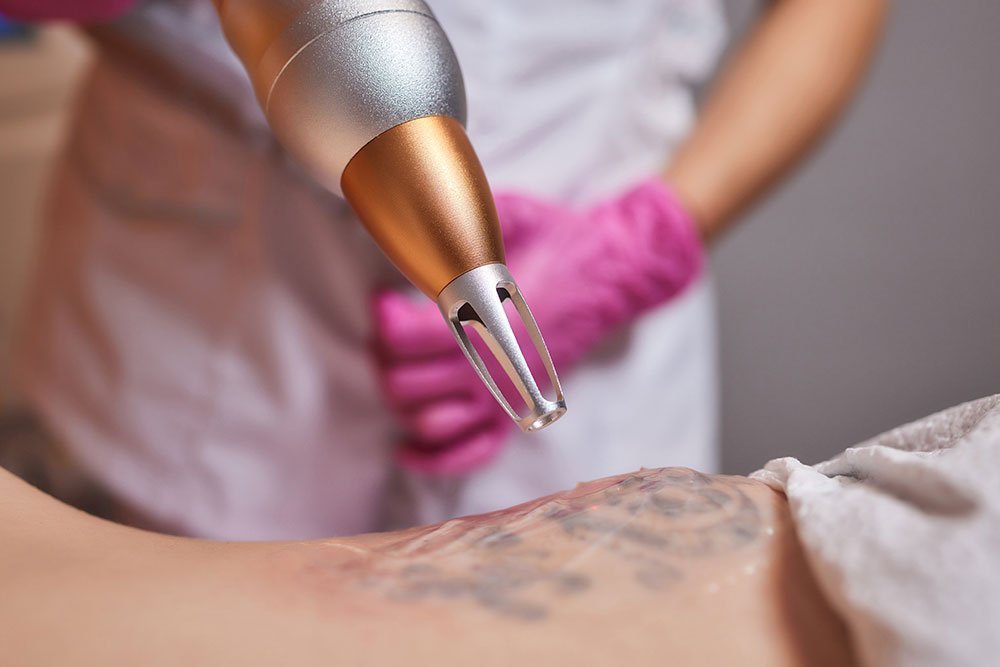 First session of laser tattoo removal @renewallaser. The reaction of the  laser gives an appearance of the tatt… | Laser tattoo, Tattoo removal,  Laser tattoo removal